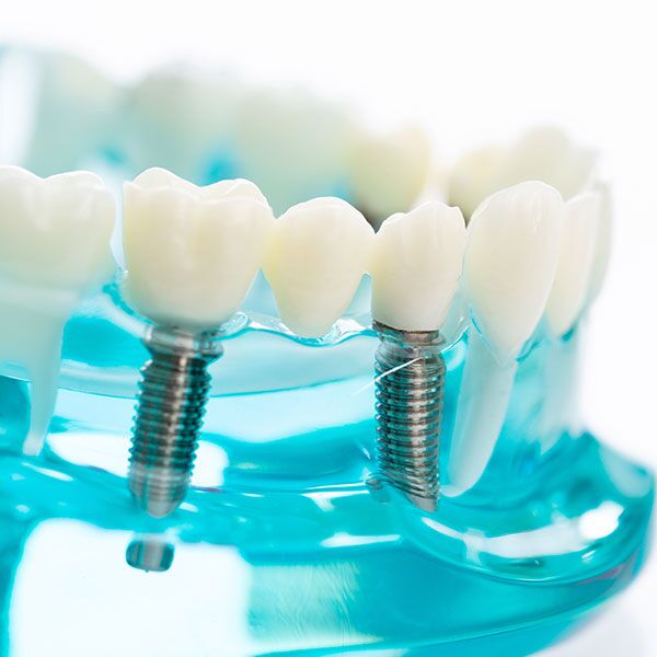 Dental implants with visible screws