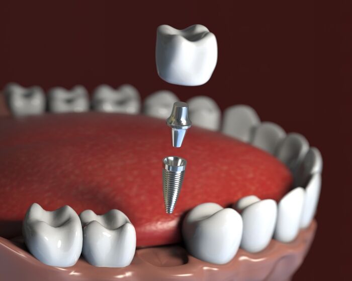 Titanium dental implant model showing osseointegration with jawbone