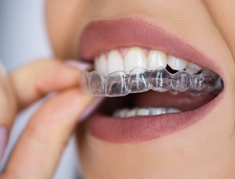 A close-up of a person's mouth using invisalign