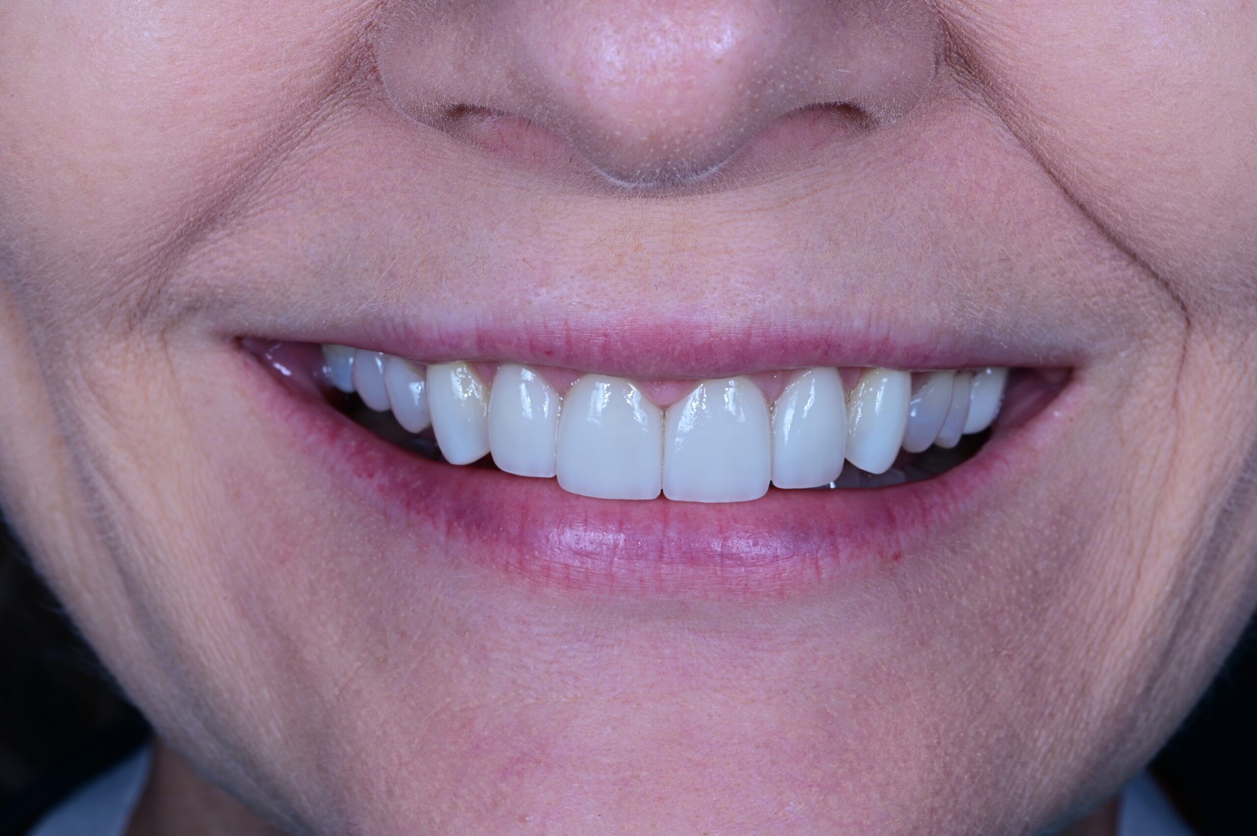 After porcelain veneers beautiful smile transformation S&C Dental