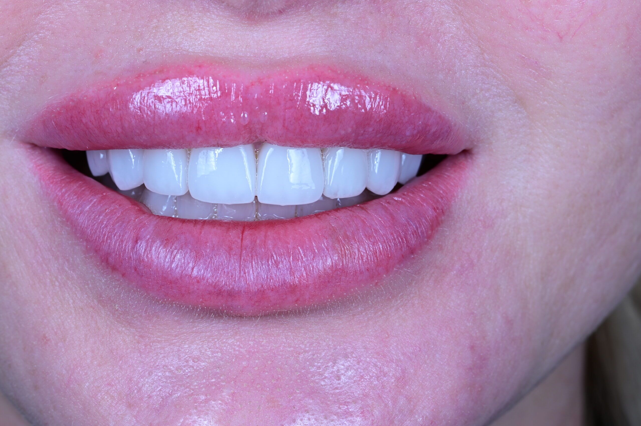 After custom veneers bright white smile S&C Dental Scottsdale
