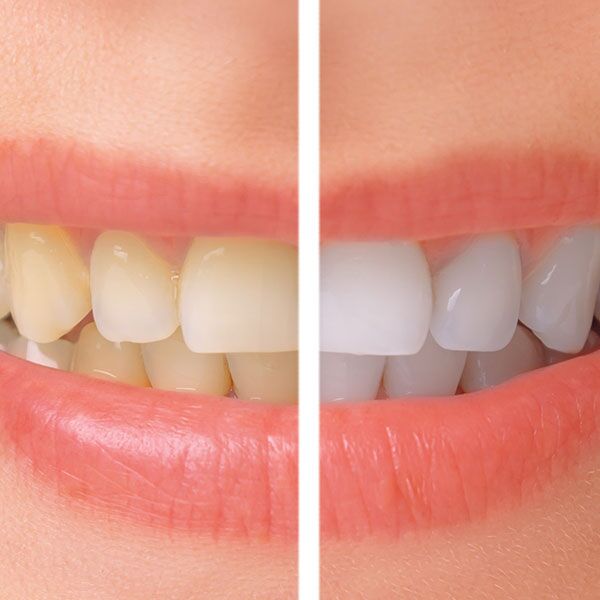 Close-up of before and after teeth cleaning