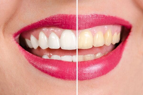 Smile makeover teeth whitening before and after