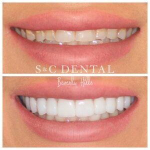 Smile Comparison of a woman before and after Dental Veneers by S&C Dental 