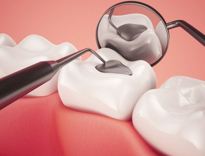 Amalgam composite Filling Checkup