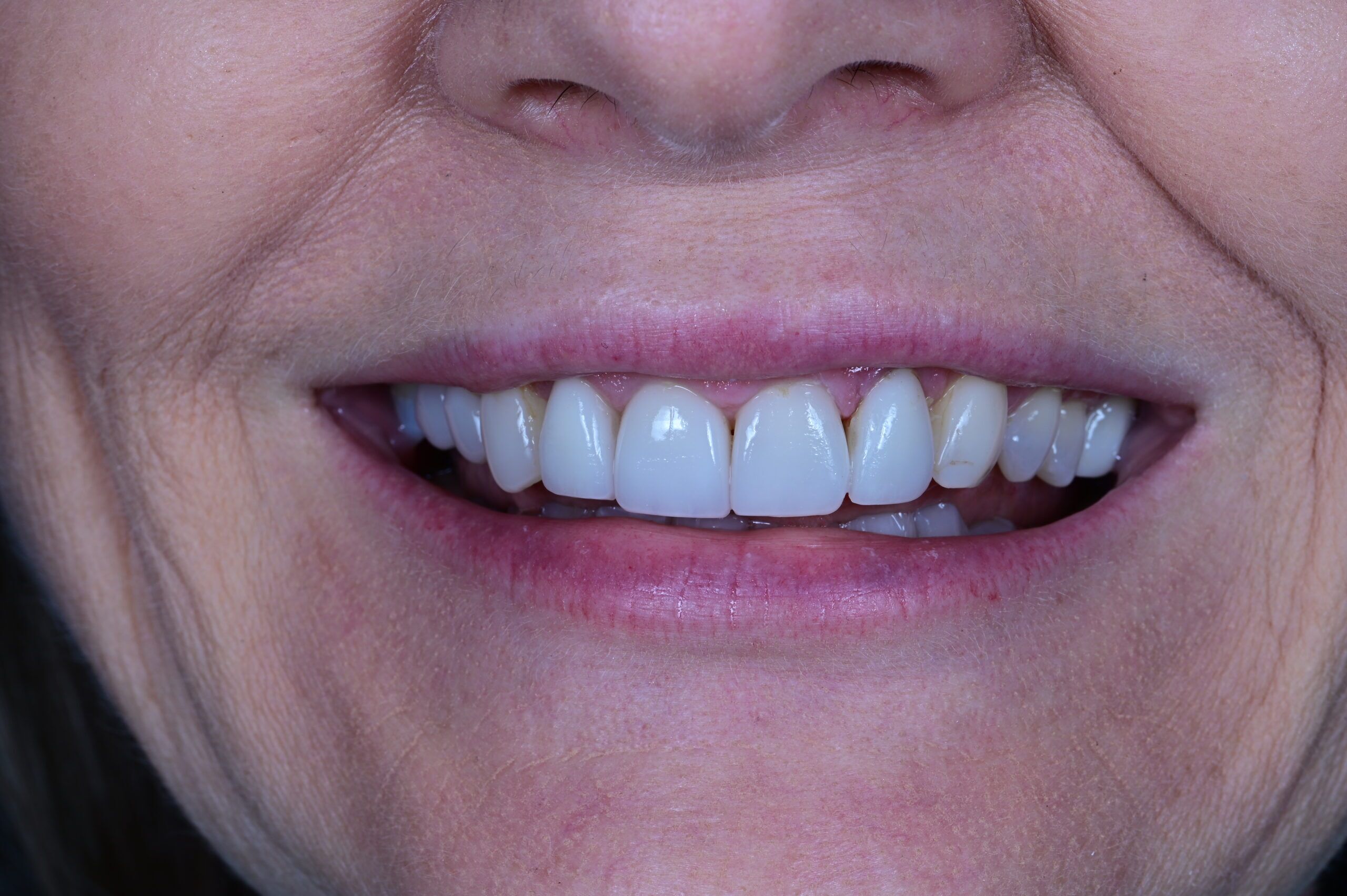Before porcelain veneers patient smile Scottsdale