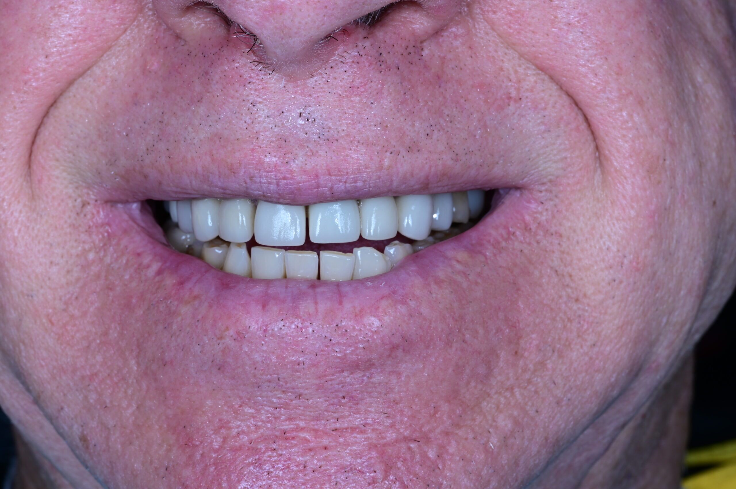 Before dental veneers male patient worn teeth