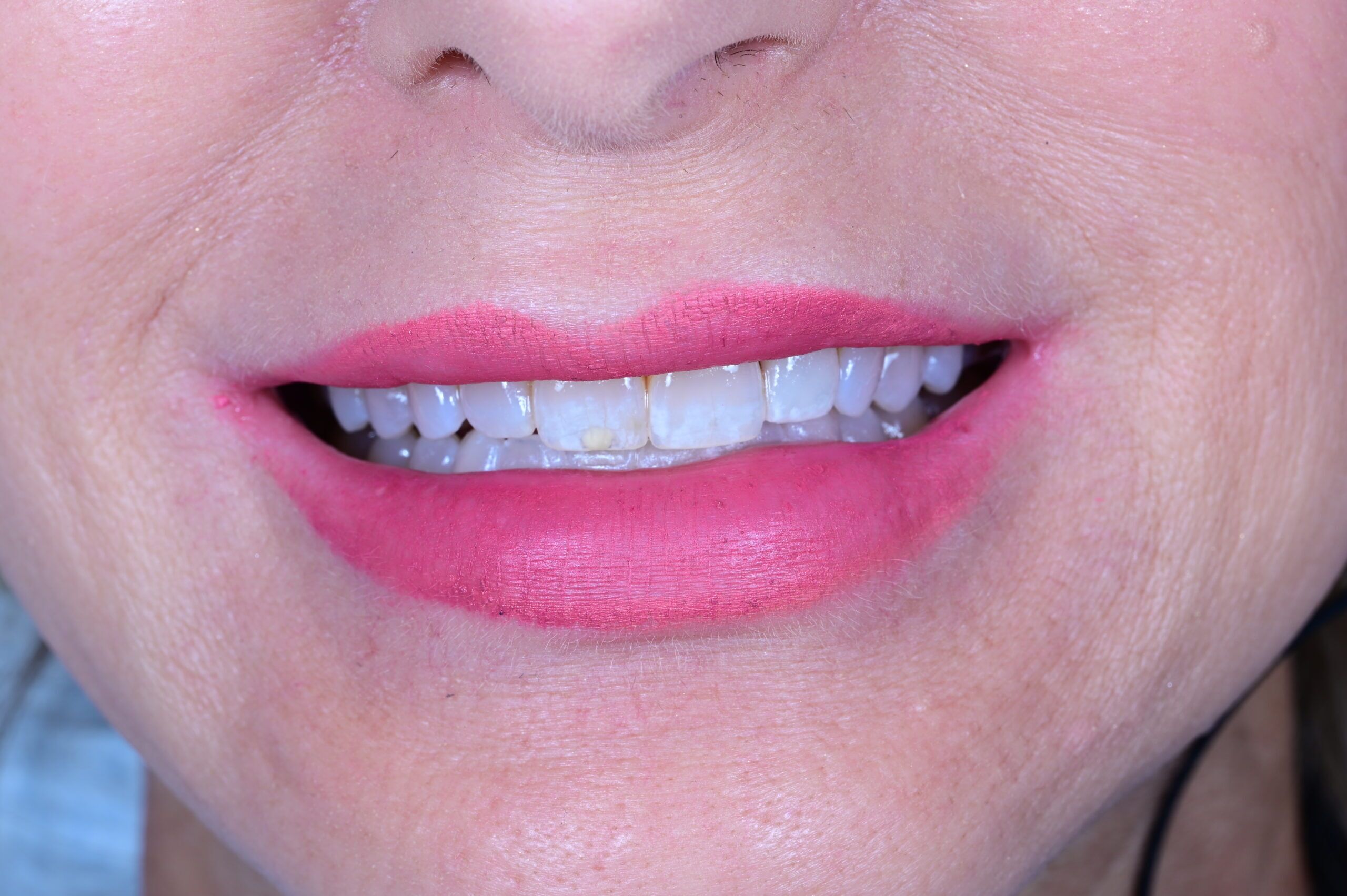 Before veneers uneven tooth color patient