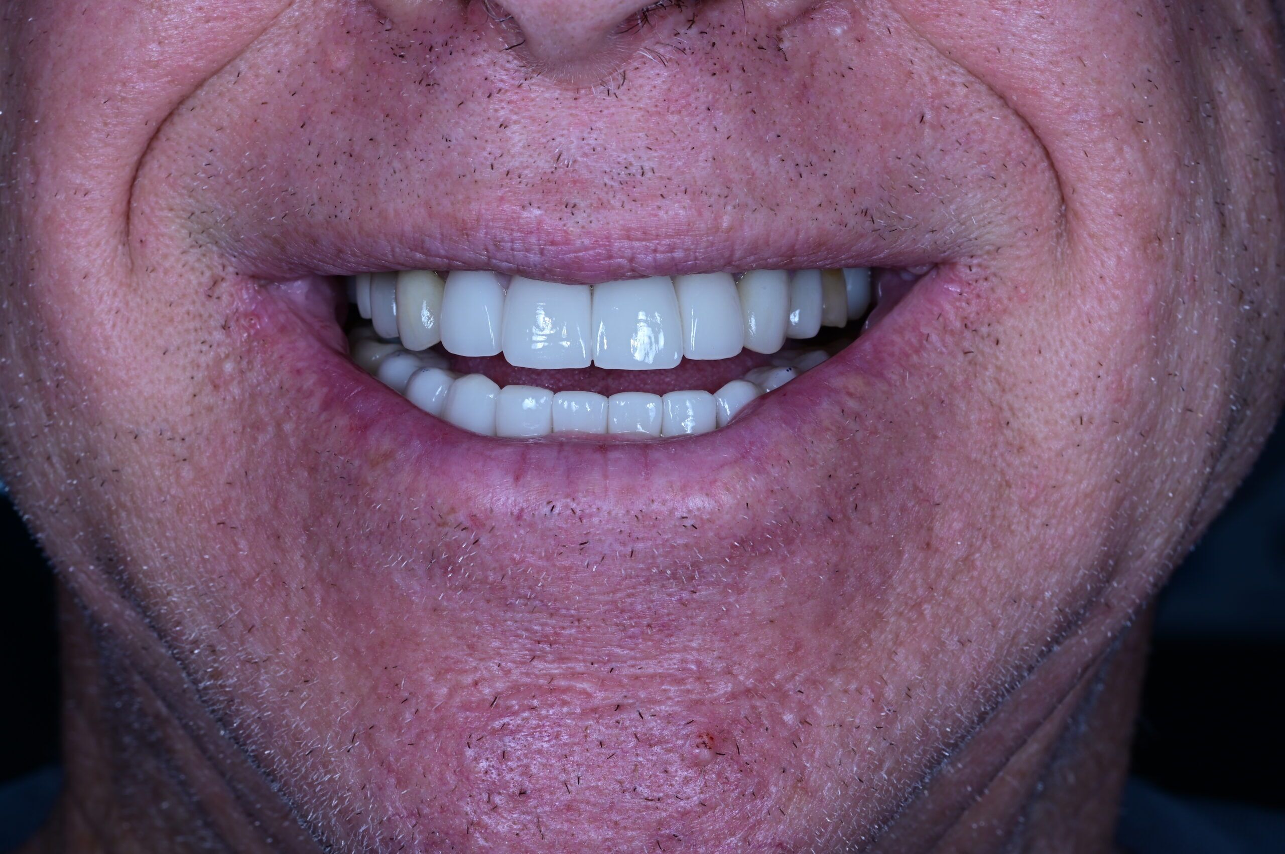 After custom veneers male patient natural looking smile Scottsdale