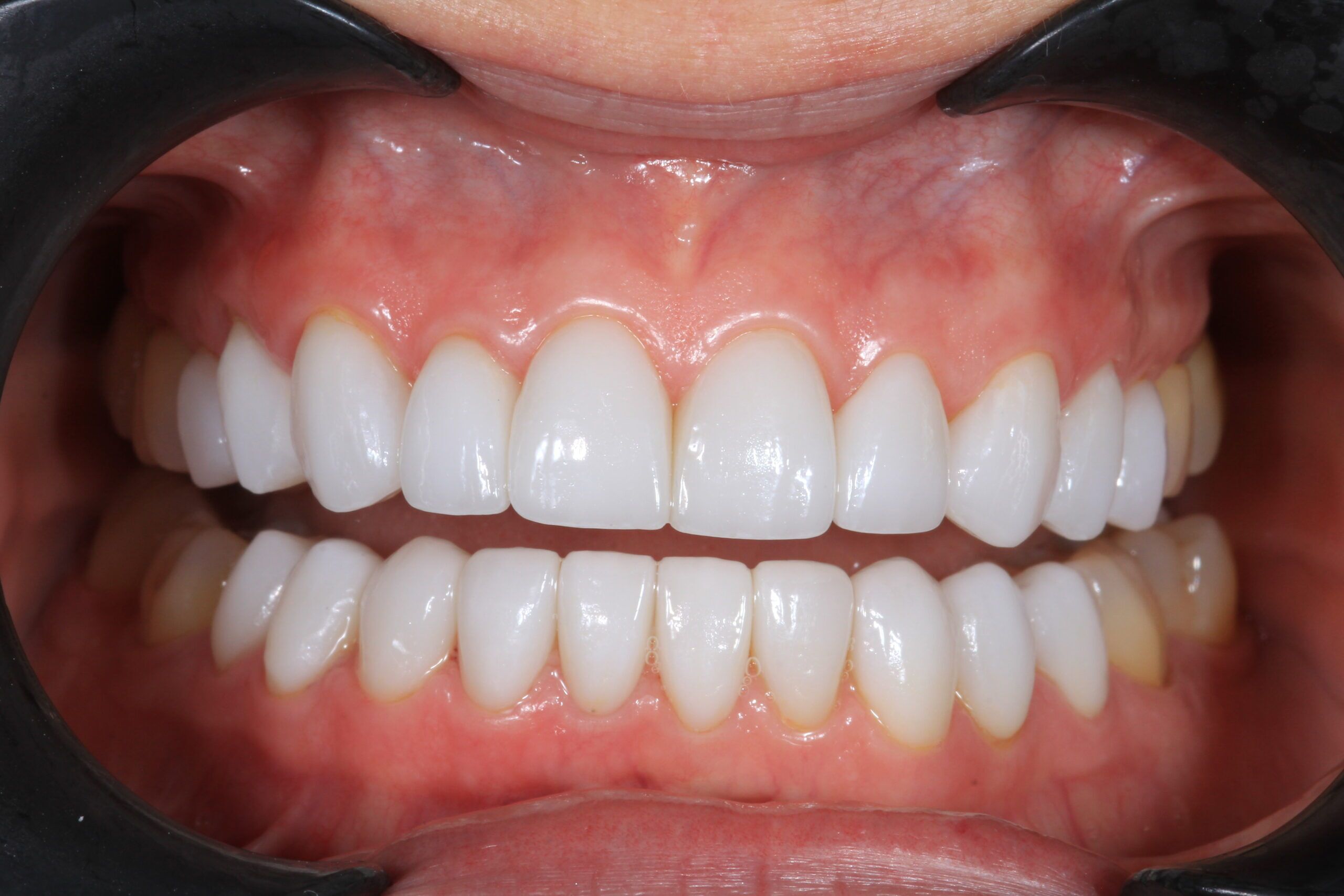 After full arch porcelain veneers complete smile makeover Scottsdale